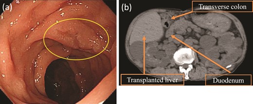 Upper gastrointestinal endoscopy and abdominal plain CT findings. (a) Upper gastrointestinal endoscopy showing the elevated lesion (10 mm in diameter) at the opposite side of the ampulla of Vater. (b) CT showing the transplanted liver very close to the transverse colon (axial image).