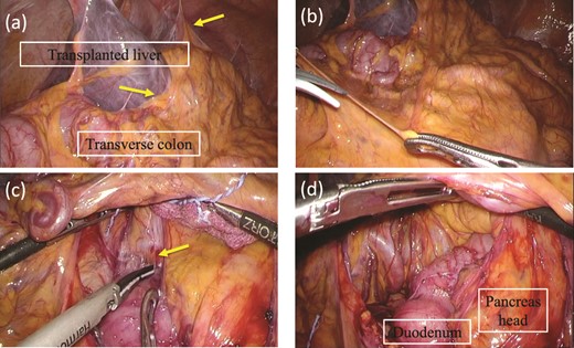Intraoperative findings before ESD. (a) The liver adheres to the upper abdominal wall and transverse colon as expected (arrow). (b) The transvers mesentery is dissected. (c) There is strong adhesion around the duodenal bulb because of the previous surgery (arrow). (d) An adequate space around the tumor at the second portion of the duodenum is made.