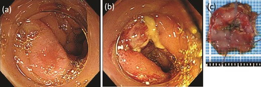 ESD was performed. (a) Before dissection. (b) After dissection. (c) The resected specimen.