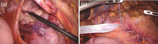Intraoperative findings after ESD. (a) The seromuscular layer of the mucosal defect lesion is sutured laparoscopically to reinforce it. (b) After confirming sufficient reinforcement of the defect and no bleeding nor passage obstruction by both upper gastrointestinal endoscopy and laparoscopy, the transverse colon mesentery is closed to finish the operation.