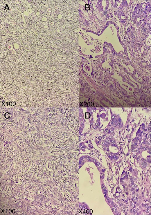 Representative micrographs of the tumor; tumor exhibits a combination of architectural patterns (A), notably glandular, tubular cordonal (B), and spindled/solid (C); certain glands and tubules contained eosinophilic colloid-like material (+); tumor cells are medium-to-large in size, possessing eosinophilic cytoplasm and vesicular, anisokaryotic nuclei, sometimes highly atypical with nuclear overlap, prominent nucleoli, and increased mitotic activity (D); (hematoxylin–eosin; A, C: × 100, B: × 200, D: × 400).