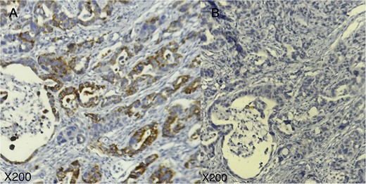 Immunohistochemical profile of the tumor; tumor cells are positive for TTF1 (A) and negative for GATA3 (B); (A, B: × 200).