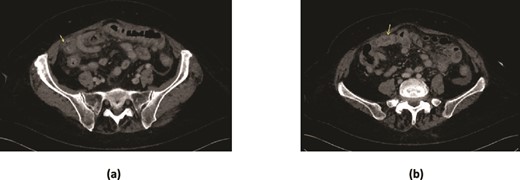 CT scan demonstrating (a) marked mural thickening of the small bowel in the right lower quadrant with areas of mural discontinuity (arrow) and peritoneal free fluid suggestive of perforation (b) ovoid soft tissue density in a small bowel loop, with collapsed small bowel loops distally.