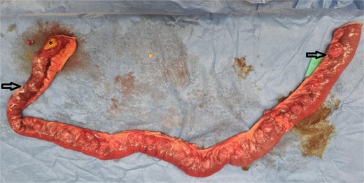 Intraoperative photo of 100 cm resected mid small bowel demonstrating multiple small bowel diverticula with two areas of perforation related to it (arrows) and a gallstone distal to the perforation (star).