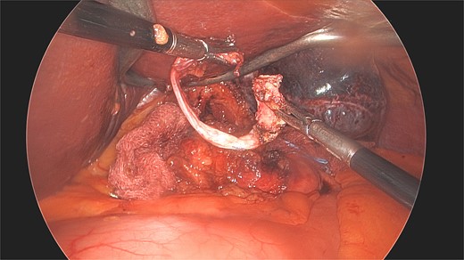 Laparoscopic view of the excised scar dissected from the stomach nine years post the removal of the patient’s LAGB.