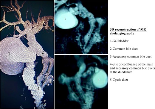 3D reconstruction of MR cholangiography.