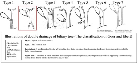 Illustrations of double drainage of biliary tree (the classification of Goor and Ebert).