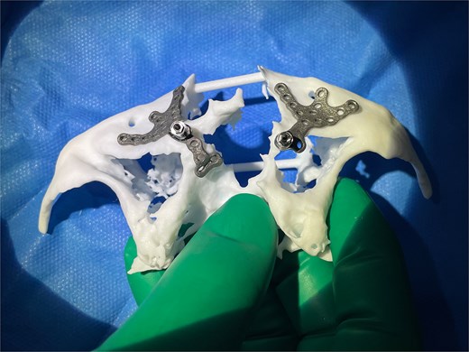 Left and right custom Osseoframes™ positioned on a 3D printed model of patient's native bone prior to implantation.