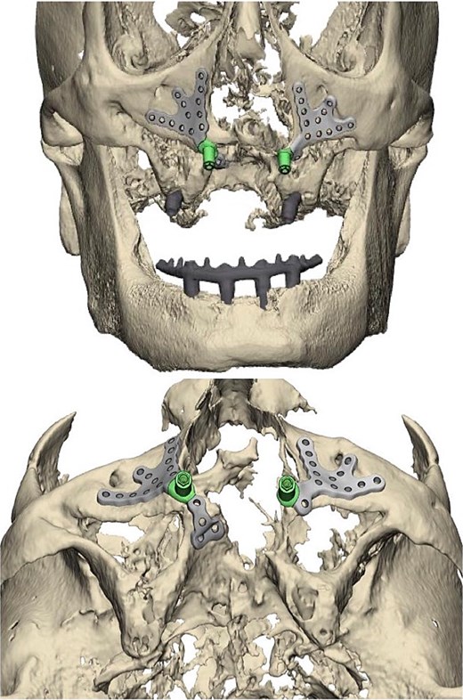 Left and right custom subperiosteal implant placement digitally modeled in pre-surgical report provided by product manufacturer.