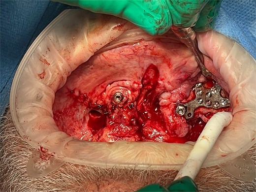 Intraoperative photo showing the right subperiosteal post emerging through the gingiva after soft tissue closure. The left subperiosteal implant frame and post is exposed with soft tissue retracted.