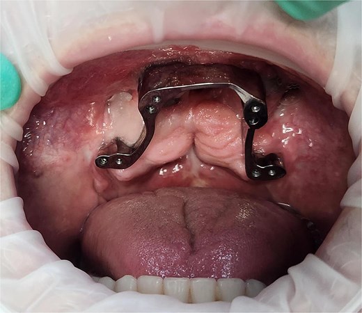 Photograph of the dental bar used to support the final dental prosthesis 6 months following surgery. Note the pre-existing tuberosity implants posteriorly.