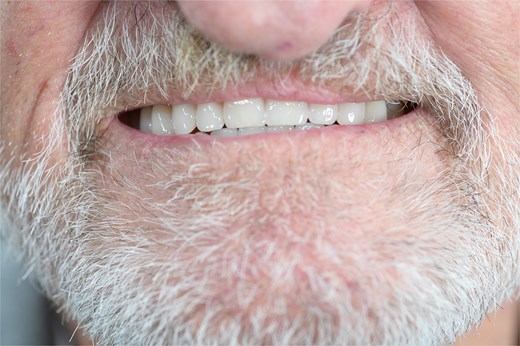 Photograph of the patient's prosthesis supplied by the combination of subperiosteal and endosseous implants 6-months post-surgery.