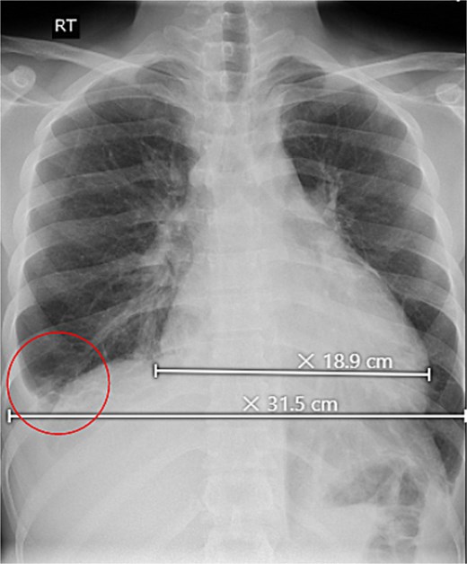 Upright chest X-ray, revealed an increase in cardiothoracic ratio with a minimal right-sided pleural effusion (circle).