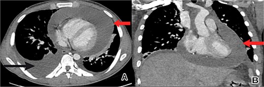 Chest CT scan showed a large pericardial effusion. (A) An axial view revealed a pericardial effusion (indicated by the upper arrow) and a right-sided pleural effusion (lower arrow). (B) A coronal view revealed a pericardial effusion (arrow) with small right heart chambers.