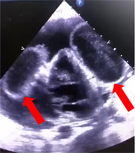 Cardiac echocardiography showed that the right ventricle was compressed by an oval-shaped large intrapericardial structure representing the cysts (arrows).