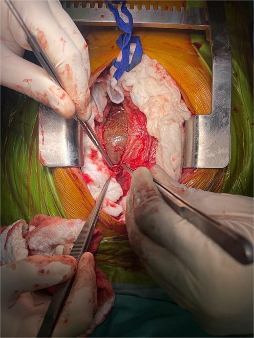 Intraoperative view of the pericardial hydatid cyst.