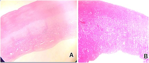 Histological examination showed (A) low-power microscopic image illustrating the outer acellular laminated membrane, a transparent nucleated lining, and the outer fibrotic layer and (B) high power view of the image illustrating the outer acellular laminated membrane and the outer fibrotic layer with granulation tissue with increased eosinophils. Note focal hemorrhage is evident.