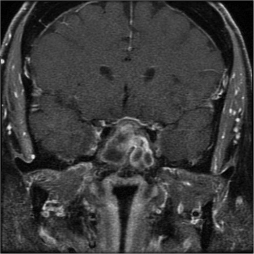 A coronal brain MRI showing a heterogeneous, enhancing lesion located within the sphenoid sinus, extending superiorly to the sellar and parasellar regions. The mass shows irregular borders and appears to cause a mild compression of the optic chiasm.