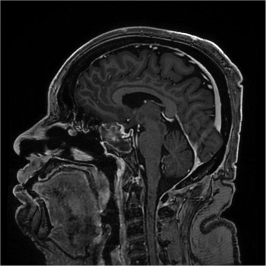 A sagittal brain MRI reveals the same mass with superior extension to the sellar and suprasellar regions. The lesion is exerting a compression to the optic chiasm. The mass effect extends posteriorly toward the clivus, with irregular margins indicating invasive potential. Adjacent structures like the pituitary stalk appear to be displaced.