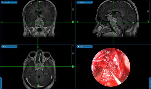An image-guided intraoperative view of a sellar tumor.