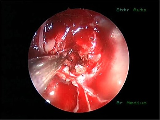 An intraoperative picture of vascular sellar lymphoma.