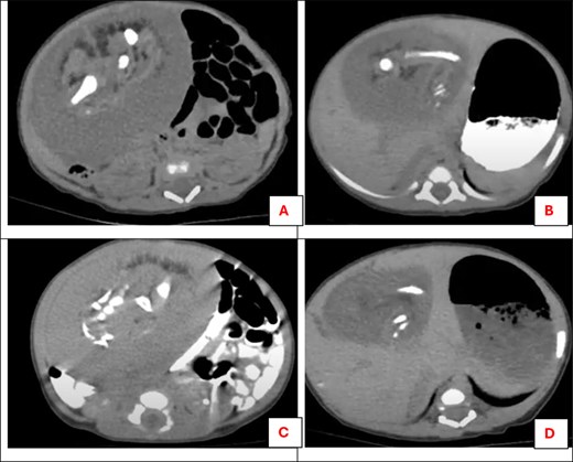 Post-contrast CT scan for the abdomen showing a heterogeneous soft tissue mass related to the lower part of the liver: (A) malformed skeletal parts resembling long bones, (B) cystic areas of fat attenuation and foci of calcifications of long bone, (C) malformed skeletal parts resembling three vertebrae, (D) cystic areas of fat attenuation.