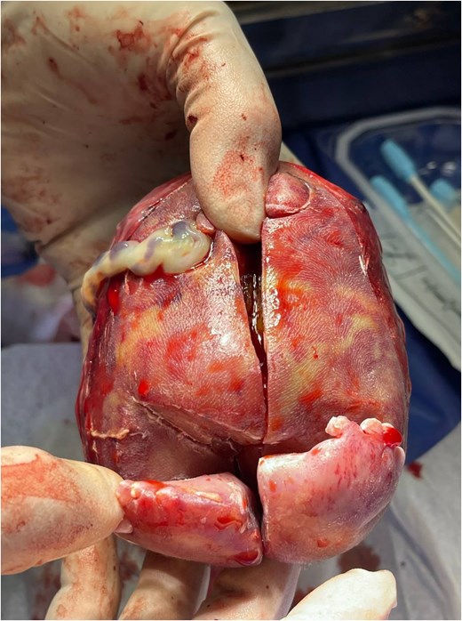 The mass after removal of the covering sac. Note the presence of two limbs and an umbilical cord.