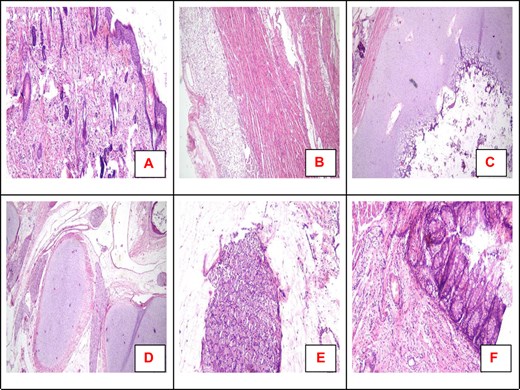 Microscopic examination revealed the presence of skin (A), skeletal muscles, and fat (B). Sections from the limbs revealed cartilage with a minimal amount of bone marrow. Vertebral column with nerve bundles (D) and ganglia are also detected (E). Parts of the intestine are also detected (F). All are hematoxylin and eosin (H&E). Magnification 40× (A–D); 100× (E, F).