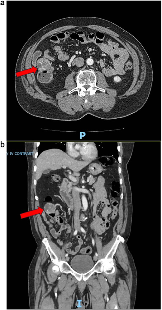 (a) CT abdomen/pelvis axial and coronal views during emergency department presentation with cecal mass seen. (b) CT abdomen/pelvis axial and coronal views during emergency department presentation with cecal mass seen.