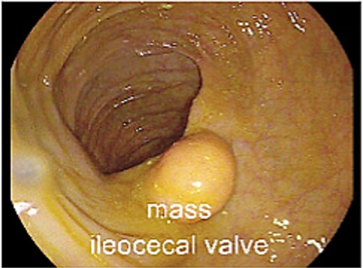 Cecal mass seen during colonoscopic evaluation.