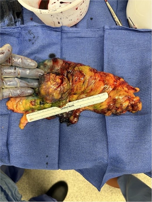 Ex-vivo gross surgical specimen following right colectomy.