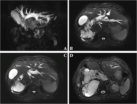 Dilated bile ducts (A). The mass shows high signal intensity on MRI T2-weighted images (B–D).