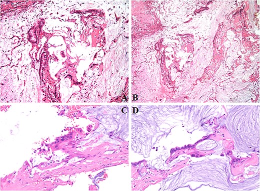 The tumor contains abundant mucin with floating adenocarcinoma cells (A–C). Chronic inflammation of the gallbladder without evidence of carcinoma involvement (D).