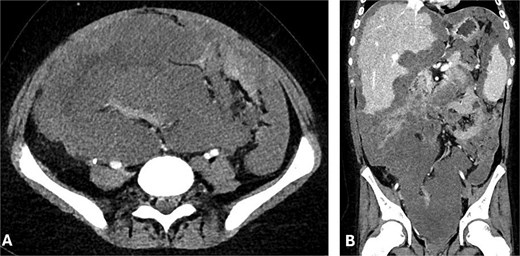 (A) Axial and (B) coronal CT abdomen showing extensive conglomerate tumour masses with irregular margins and heterogeneous attenuation, encasing and displacing peritoneal structures.