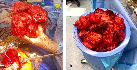 (A) Intraoperative image showing the en-bloc excision of a pelvic tumour mass with heterogeneous and lobulated morphology. (B) Extensive tumour specimen resected weighing ~10 kilograms.
