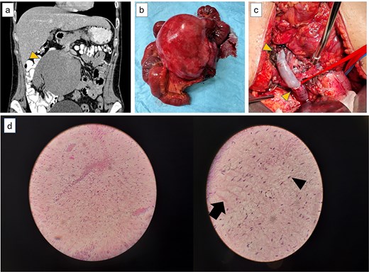 (a) Computer tomography showing the large lesion (arrow) originating from the root of the mesentery in close contact with the superior mesenteric artery and vein. (b) The resected mesenteric lesion along the jejunum and part of the SMV. (c) Vascular reconstruction using a cadaveric graft with anastomoses to the distal and proximal SMV (arrows). (d) Μesenteric fibromatosis of desmoid type (arrow). Spindle-shaped nuclei with a fibroblast-like morphology (arrow head). Low magnification (right)—higher magnification (left).