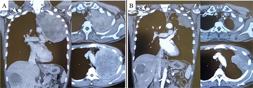 Pre-treatment CT revealed a large mass exceeding 13 cm in the left lung apex, with invasion into the first through fifth ribs (A). Following treatment with nivolumab with ipilimumab, the tumor showed marked shrinkage (B).