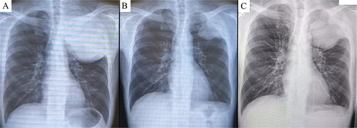 Chest X-ray prior to treatment revealed a large mass extending from the left lung apex to the upper lung field (A), which markedly decreased in size following immunotherapy (B). However, during the 4-week interval between the end of immunotherapy and surgery, the tumor demonstrated regrowth (C).