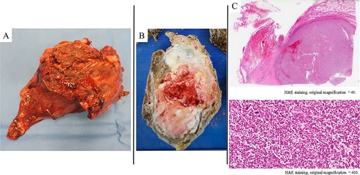 A poorly defined, grayish-white mass measuring 100 × 50 mm, observed macroscopically in the chest wall and left upper lobe (A, B). Histologically (H&E staining), the tumor showed solid proliferation of pleomorphic tumor cells accompanied by fibrosis, hyalinization, and infiltration of inflammatory cells (C).