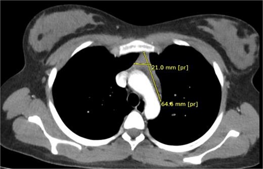 Preoperative thoracic CT showing a 61 × 24 mm homogeneous anterior mediastinal mass.