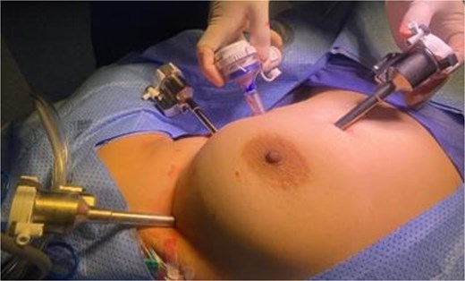 Port placement for robotic-assisted thymectomy using the Da Vinci Xi system.