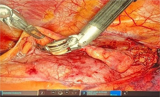 Intraoperative robotic dissection of the inferior thymic pole.