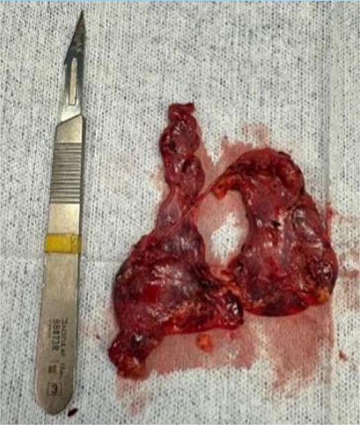 Resected thymic tissue with surrounding mediastinal fat.