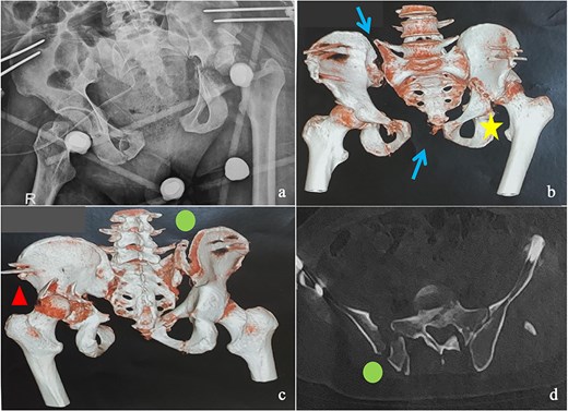 (a) Anteroposterior pelvic X-ray showing delayed pelvic and acetabular fractures. (b) Anterior view of the pelvis on 3D section: pubic symphysis disjunction and right sacroiliac dislocation (arrows), transverse component of the left acetabular fracture (star). (c) Posterior view of the pelvis on 3D section: right crescent fracture associated with right sacroiliac dislocation (circles), fracture of the posterior wall of the left acetabulum associated with posterior dislocation of the femoral head (triangle). (d) Axial section of the pelvic CT-scan: right crescent fracture Kumar-Day 2 (green arrow).