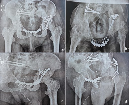 Immediate postoperative X-rays. (a) Anteroposterior pelvic X-ray. (b) Inlet view of the pelvis. (c) Alar oblique view of the pelvis. (d) Obturator oblique view of the pelvis.