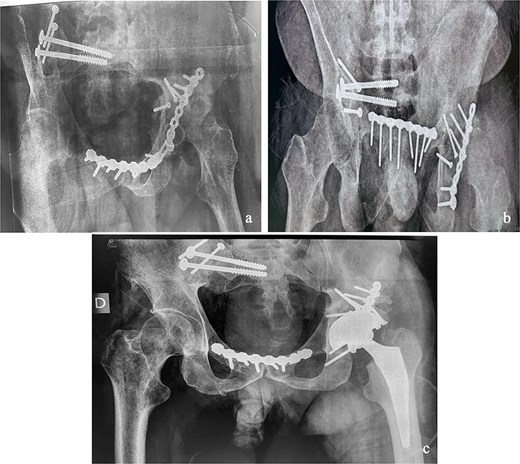 (a and b) Inlet and obturator oblique views showing a left hip osteoarthritis with subluxation of the femoral head. (c) Anteroposterior pelvic X-ray: left total hip arthroplasty, acetabular bone reconstruction with a screwed structural bone graft.