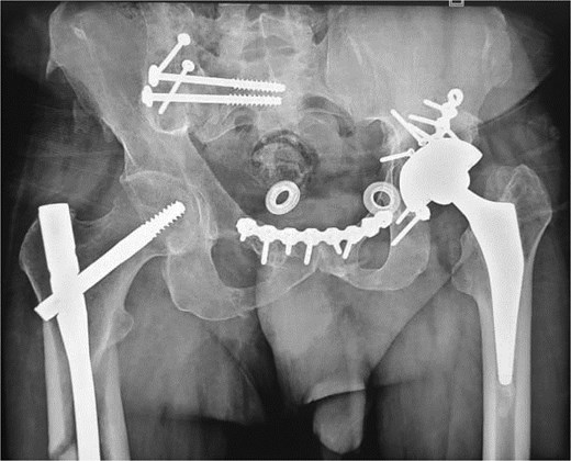 Pelvic X-ray at the last follow-up.