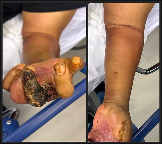 Initial presentation of left upper extremity. Third digit with gangrenous necrosis, with erythema and underlying crepitus of the arm (left picture). Forearm demonstrating erythema with underlying crepitus (right picture).