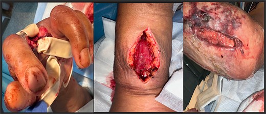 Postoperative after left upper extremity amputation and fasciotomy. Left third digit with penrose drain placement (left). Fasciotomy of volar aspect of forearm (middle). Fasciotomy of the dorsal aspect of the forearm (right).