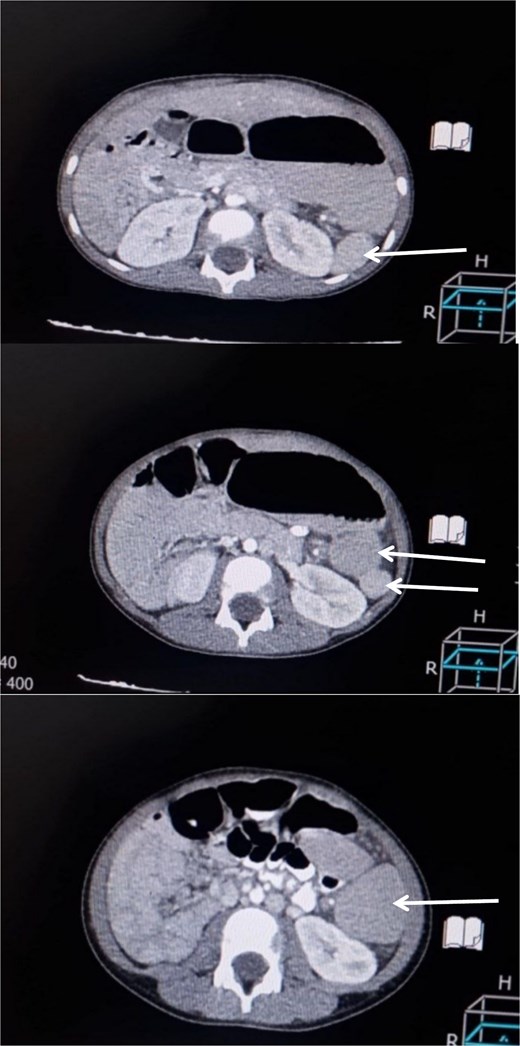 Contrast-enhanced CT scan of the abdomen demonstrating multiple spleen-like densities (arrows) can be seen in the left upper and lower quadrants of the abdomen.